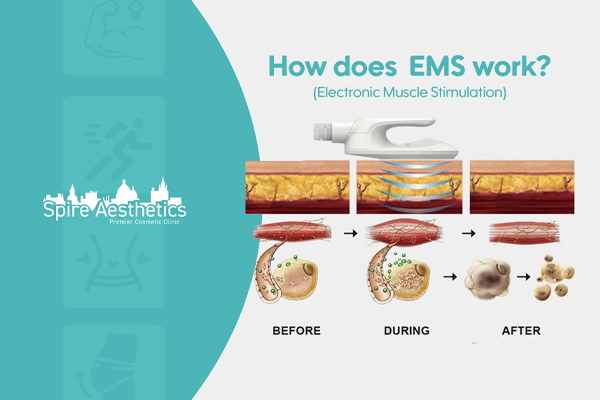 EMS treatment for post pregnancy weight loss treatment Chesham