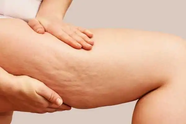 Image of woman showing leg with cellulite Chesham