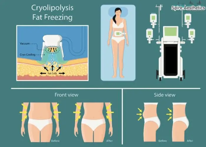 Fat freezing treatment Chesham benefits for competitions to remove stubborn fat deposits.