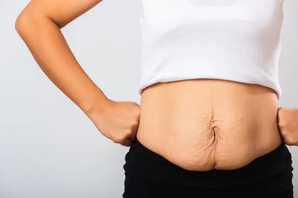 Image of a woman's stomach after weight loss with sagging skin following a gastric band Chesham