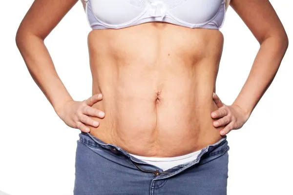sagging skin on woman's stomach after weight loss injections Chesham