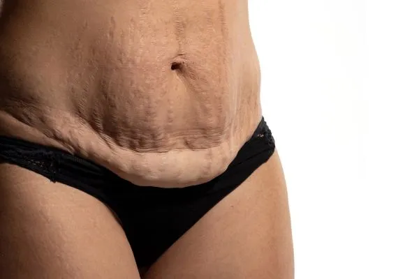Image of womans stomach after weight loss injections Chesham showing saggy skin