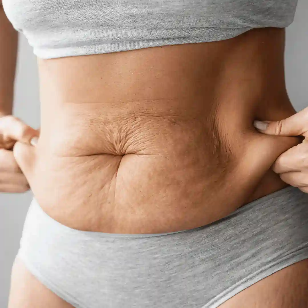 Is It Normal to Have Loose Skin After Pregnancy Chesham?