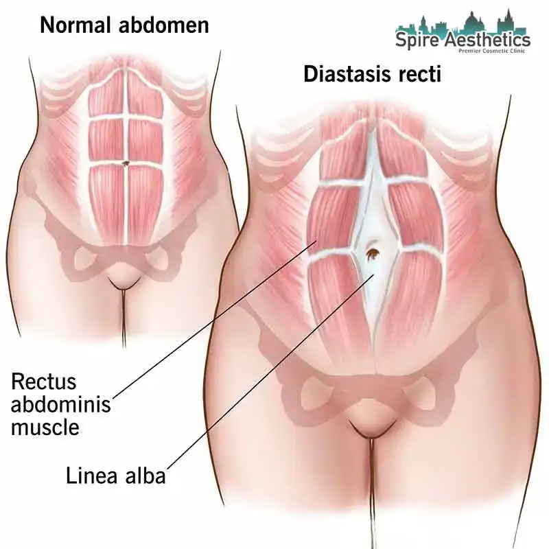 When Will My Belly Feel Normal Again Chesham?