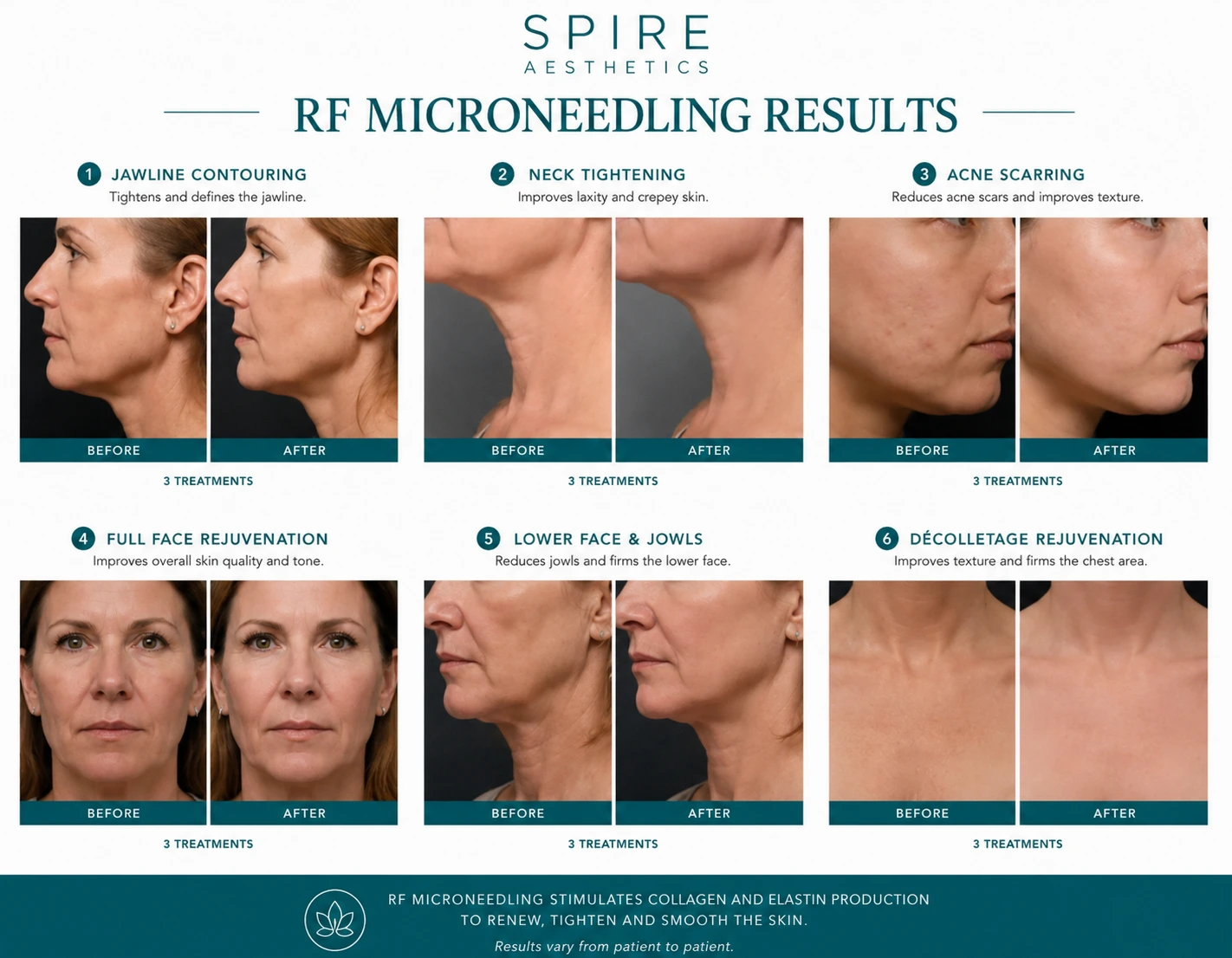 RF Microneedling Skin tightening Chesham results