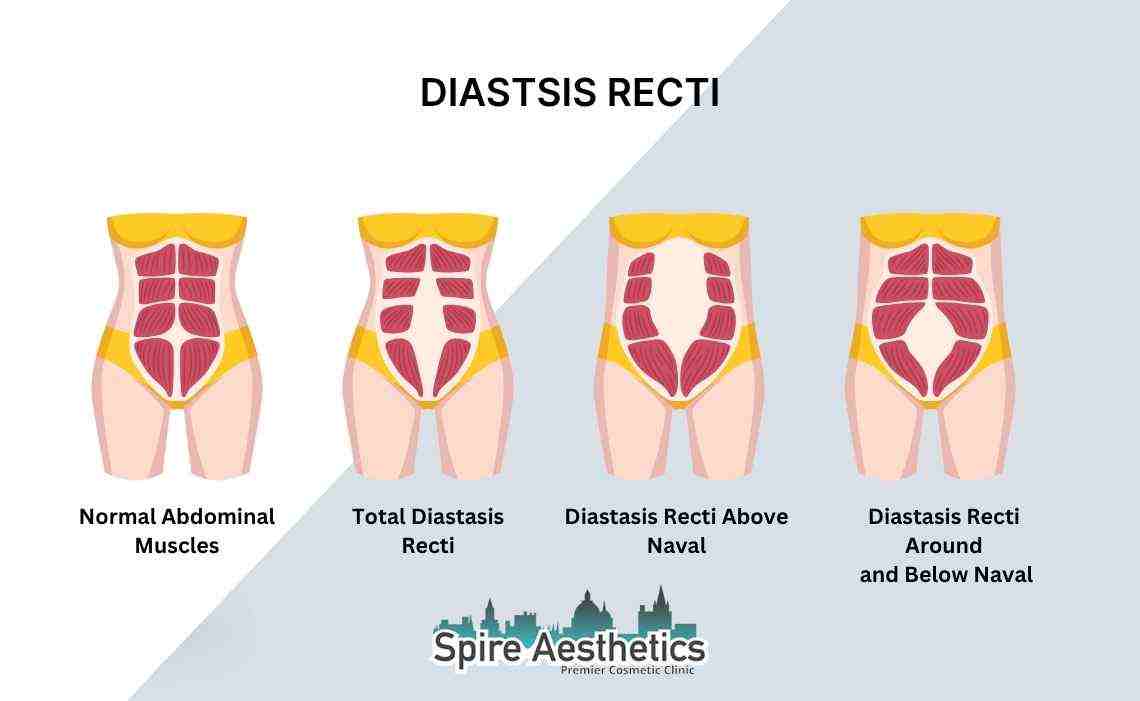 Is Non-Surgical Diastasis Recti Treatment Right for You? Common Concerns Answered Chesham